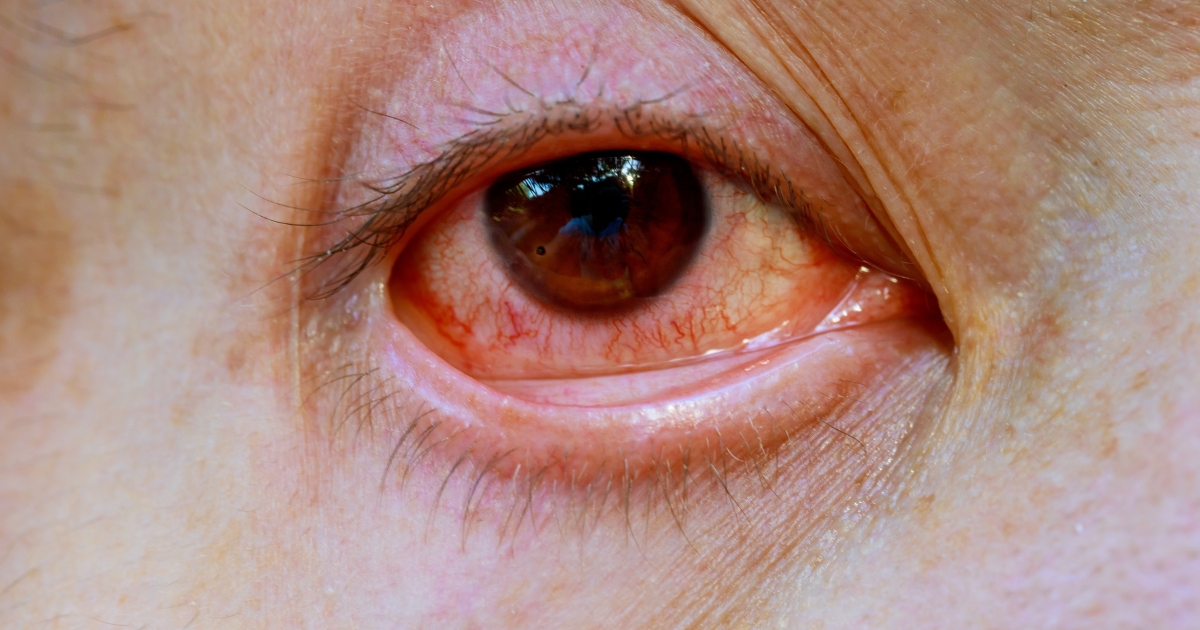 what causes eye redness and how to treat it