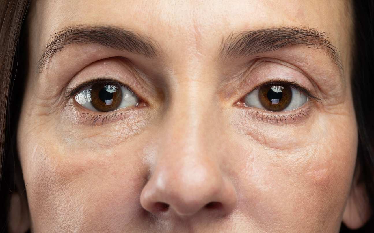 how rf tech fights puffiness fast